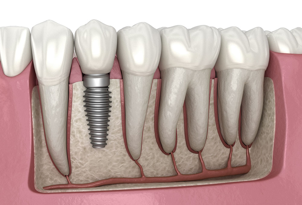 Expectations for Your First Dental Implant Consultation Appointment