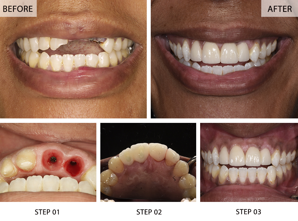 https://www.colinadental.com/services/dental-implants/